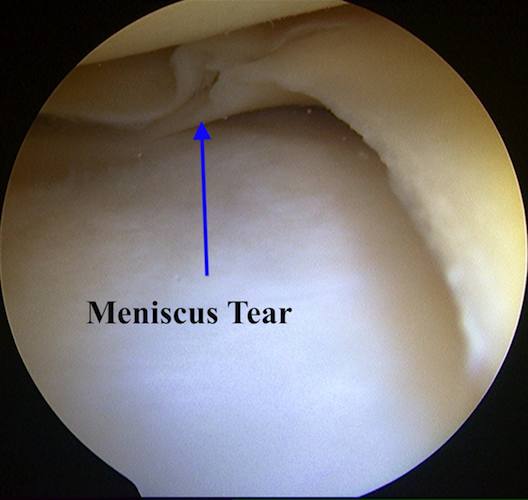 Meniscus Tear 2